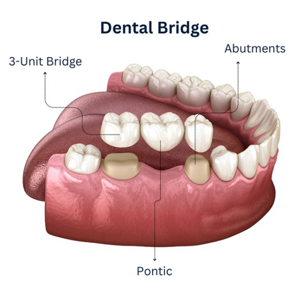 Dental-Bridge-in-Dubai-GAGA-Medical-Aesthetic-Center-Dubai-Jumeirah-UAE-M4